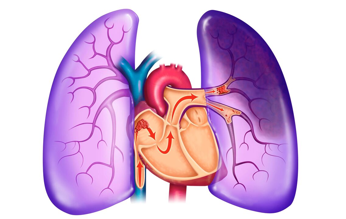pulmoner hipertansiyon